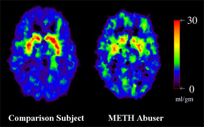PET Scans showing normal brain and METH Abuser brain - METH abuser brain shows less activity in normal regions and slightly increased activity in areas that are less active in the normal brain