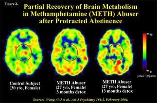 brain scans showing change in brain activity after extended abstinence from methamphetamine use - in text