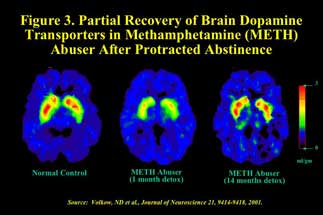 brain scans showing partial recovery in brain activity in methamphetamine abusers after protracted abstinence - in text