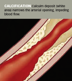 Calcification Graphic