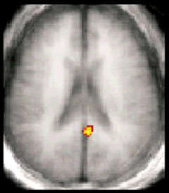 fMRI image showing activation of the posterior cingulate cortex - see caption