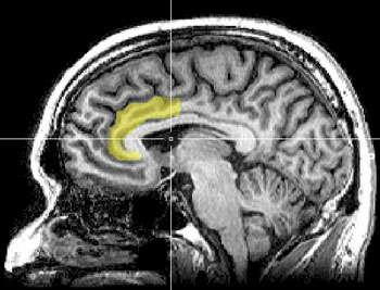 Magnetic resonance spectroscopy image shows anterior cingulate cortex as a curved yellow area deep in the cortex and toward the front of the brain. 