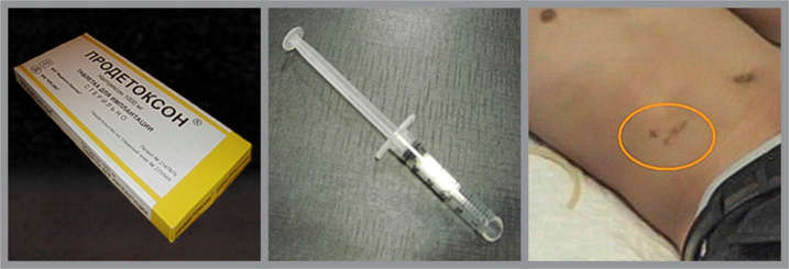 Three photos showing a naltrexone package with Russian writing; an insertion device; and the injection site circled on a person’s abdomen