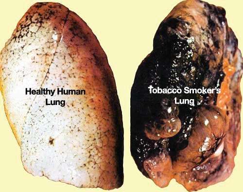 Picture of a health lung and a tobacco smokers blackened lung