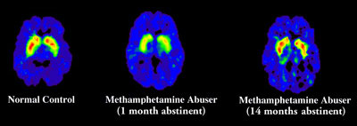 Methamphetamine Brain Scan Images