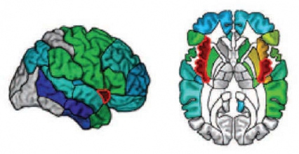 illustration showing damage to the right and left insula of the brain - see caption