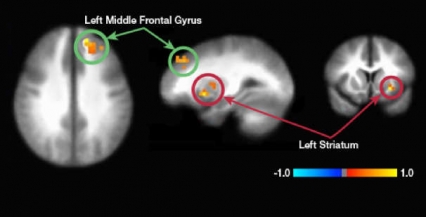 Brain scans showing the left middle frontal gyrus and the left striatum