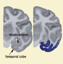 photo of brain tissues showing blue coloring in the temporal lobe representing lower activity after cocaine self-administration