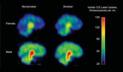 Figure 1 shows four PET tomography images in full color, two for females and two for males. Each pair of images has one PET scan from a nonsmoker and one from a smoker. The scans show the female nonsmoker’s brain has more of the radioactive compounds traced by the scans than the female smoker does in hers. The opposite is true of the male smoker, whose PET scan shows less of the compounds than the male nonsmoker’s scan. Overall, males have higher levels than females for both smokers and nonsmokers.