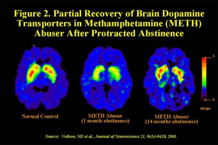 PET scans showing partial recovery of brain dopamine transporters after 1 month and 14 months compared to control