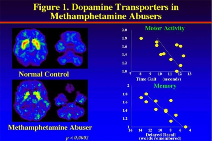 PET image showing decreased activity of dopamine transporters in Methamphetamine abusers - in text