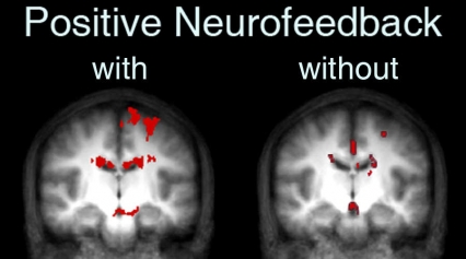Voluntary control of brain reward circuitry 