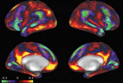 Esto muestra 4 imágenes de escáneres cerebrales desde diferentes aspectos.