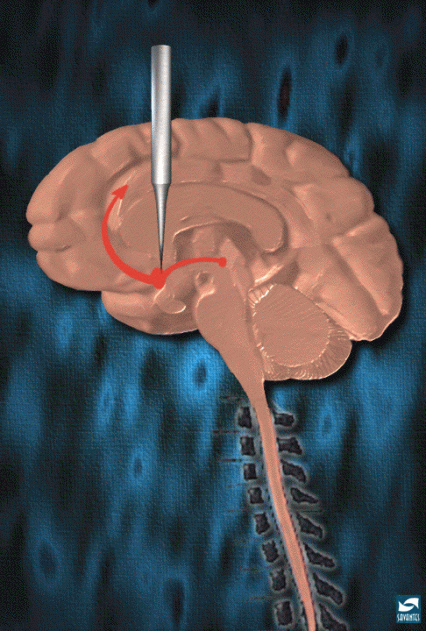 cross image of brain pointing close to nucleus accumbens