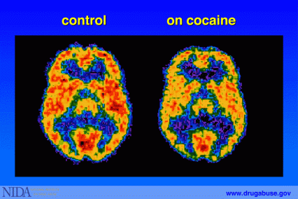 Positron emission tomography (PET) scan of a control brain and a brain on cocaine