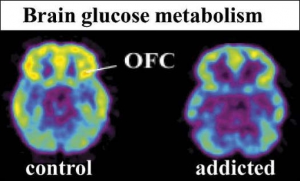 Glucose metabolism in orbitofrontal cortex (OFC) in healthy and cocaine-addicted subject.